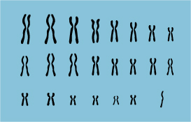 Caryotype du syndrome de Turner