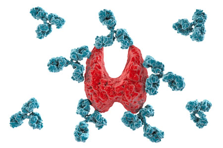 Thyroïdite auto-immune, maladie de Hashimoto : anticorps attaquant la glande thyroïde