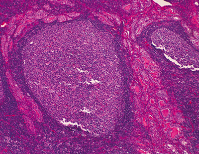 Histologique : infiltration lymphocytaire de la glande thyroïde