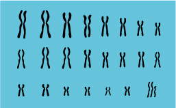 Caryotype du syndrome de Klinefelter