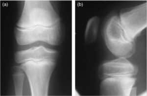 (a) vue antéropostérieure et (b) vue latérale des épiphyses